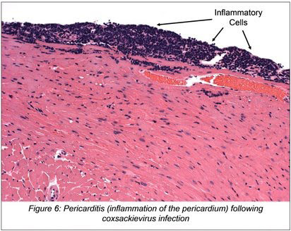 Pericarditis (inflammation of the pericardium) following
coxsackievirus infection
